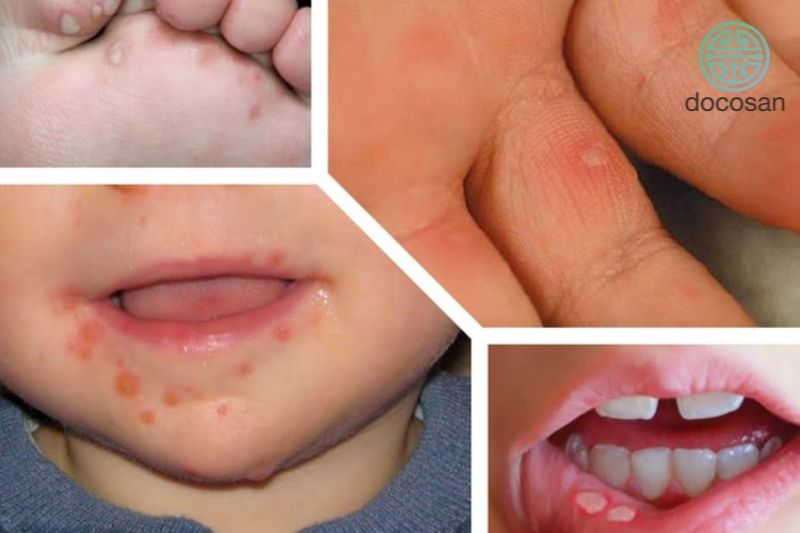 BỆNH TAY CHÂN MIỆNG VÀ CÁCH PHÒNG, CHỐNG 